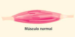 Qué es una contractura muscular